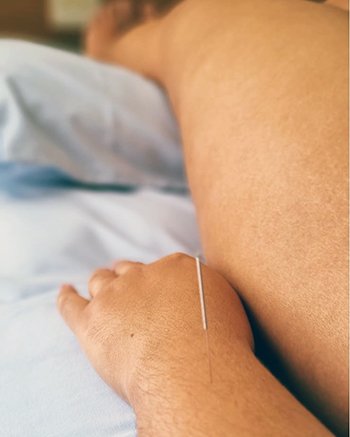 Descubra como a acupuntura se torna a chave para o alívio das dores e o despertar de uma qualidade de vida excepcional.